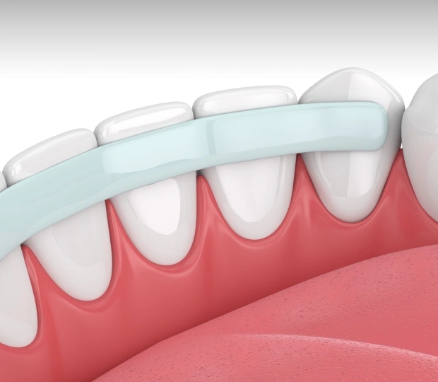 Cosmetic dental bonding repairing chipped teeth