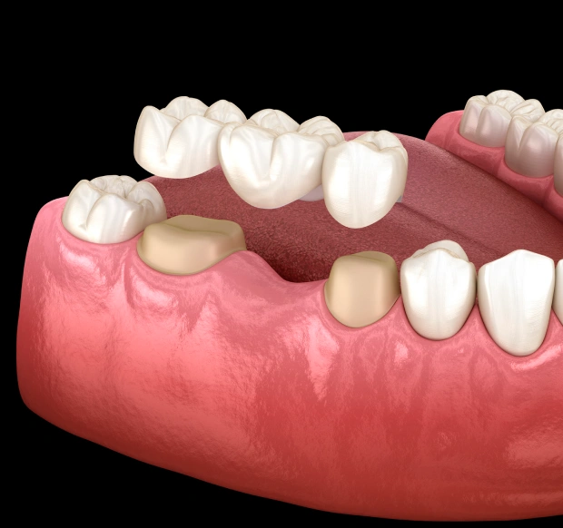 Dental bridge replacing missing teeth illustration