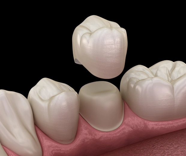 Custom dental crown restoration on a tooth