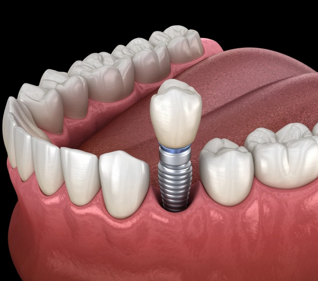 Dental implant restoration replacing a missing tooth