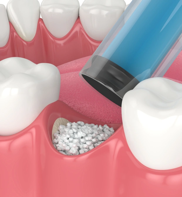Dental extraction and bone graft procedure illustration