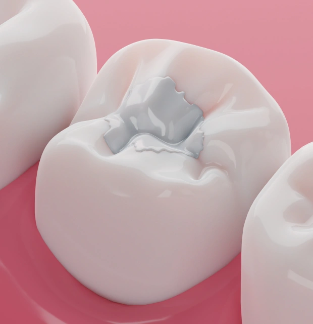 Tooth-colored composite filling illustration